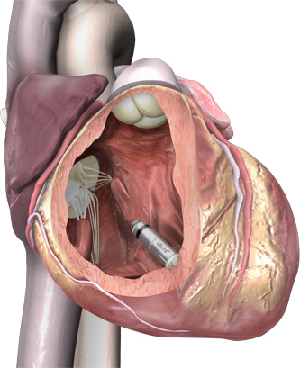 Illustration for article titled This Tiny Metal Pill Is the Smallest Pacemaker Ever Implanted